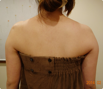 痩身施術例（キャビテーション 二の腕～背中 6回）施術前1