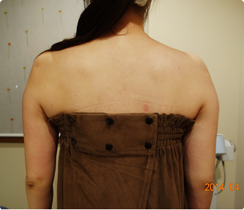 痩身施術例（キャビテーション 二の腕～背中 6回）施術結果1
