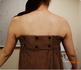 痩身施術例（キャビテーション 二の腕～背中 6回）施術結果2