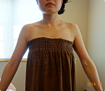 痩身施術例（キャビテーション 二の腕～背中 6回）施術結果2