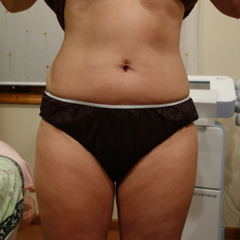 痩身（ハイフォーカス システム）お腹2回の施術後