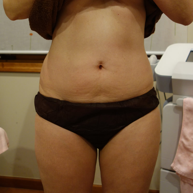 痩身（ハイフォーカス システム）お腹5回と太もも2回の施術後