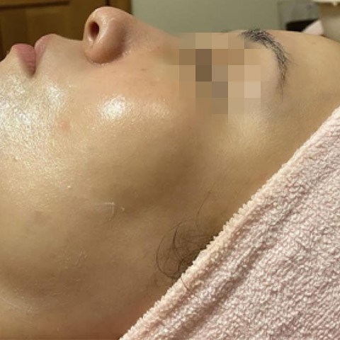 フェイシャルフルコース　(１回施術)（40代）